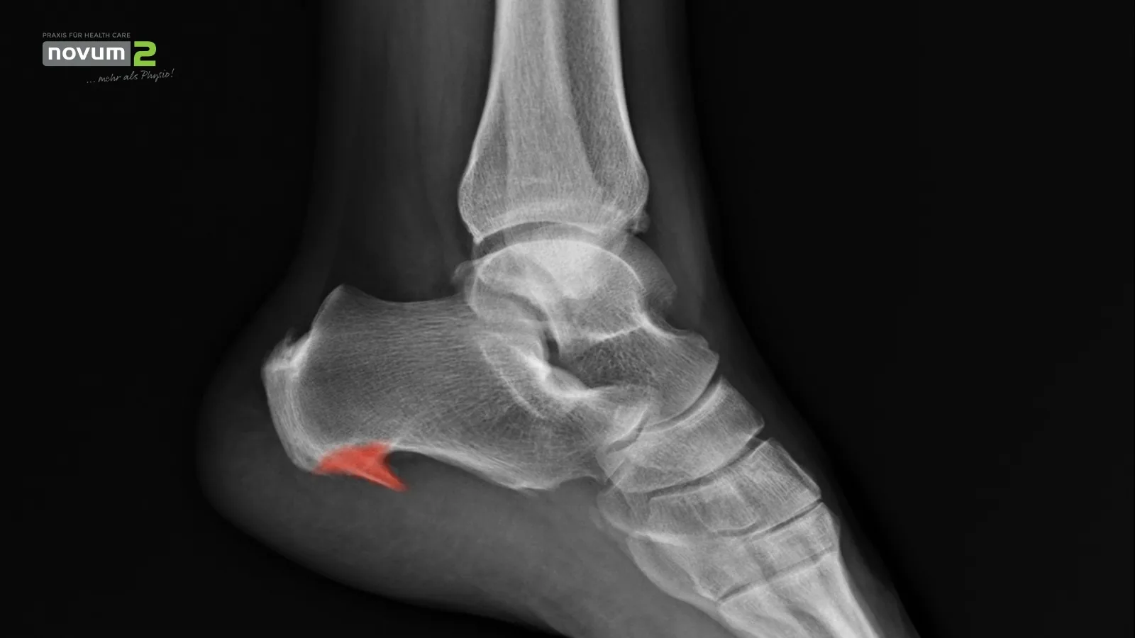 X-ray of a foot with a marked heel spur at the Novum2 physiotherapy practice