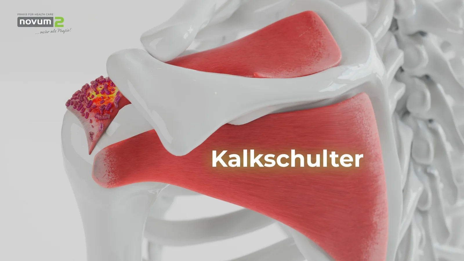 Darstellung einer Kalkschulter in der Novum2-Praxis für Physiotherapie und Gesundheitspflege